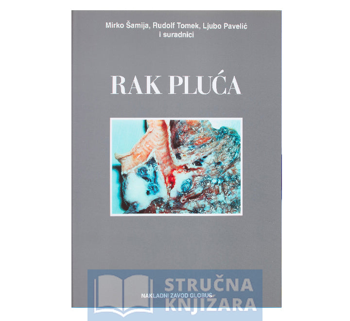 Rak pluća - Mirko Šamija, Rudolf Tomek, Ljubo Pavelić i suradnici